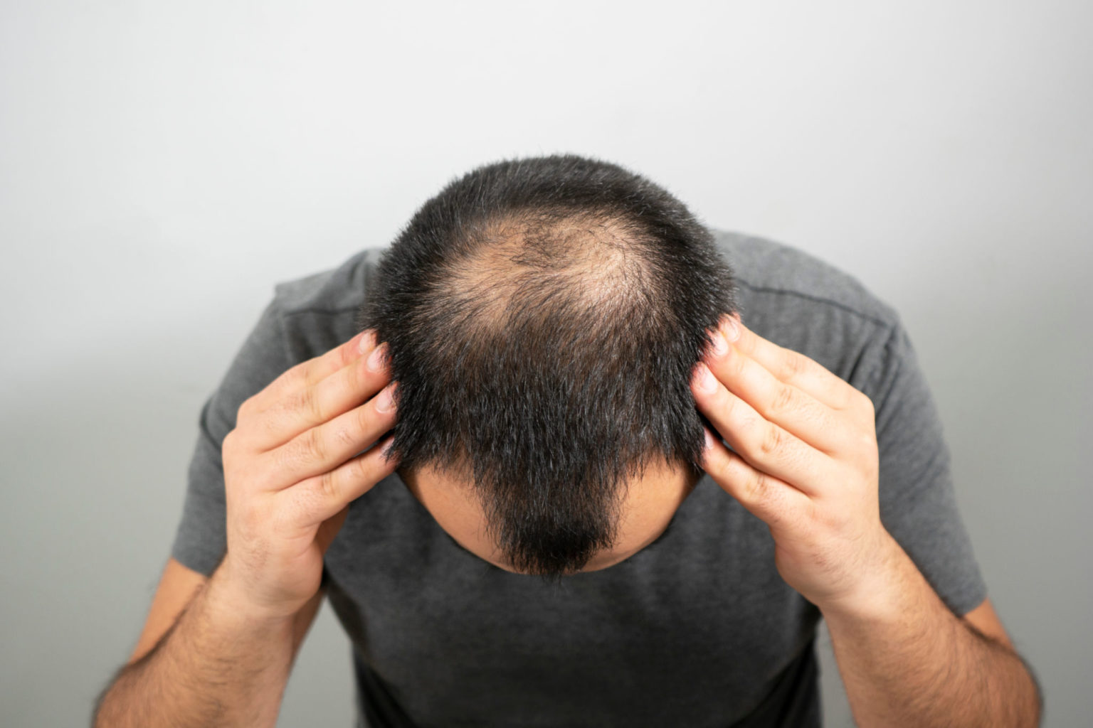 Alopecia or Hair Loss