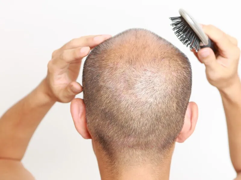 Reasons Not to Get Hair Transplant